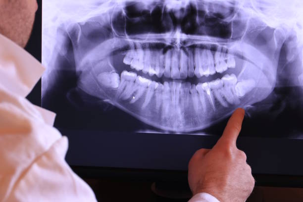 Best Emergency Wisdom Teeth Removal in Crandall, TX